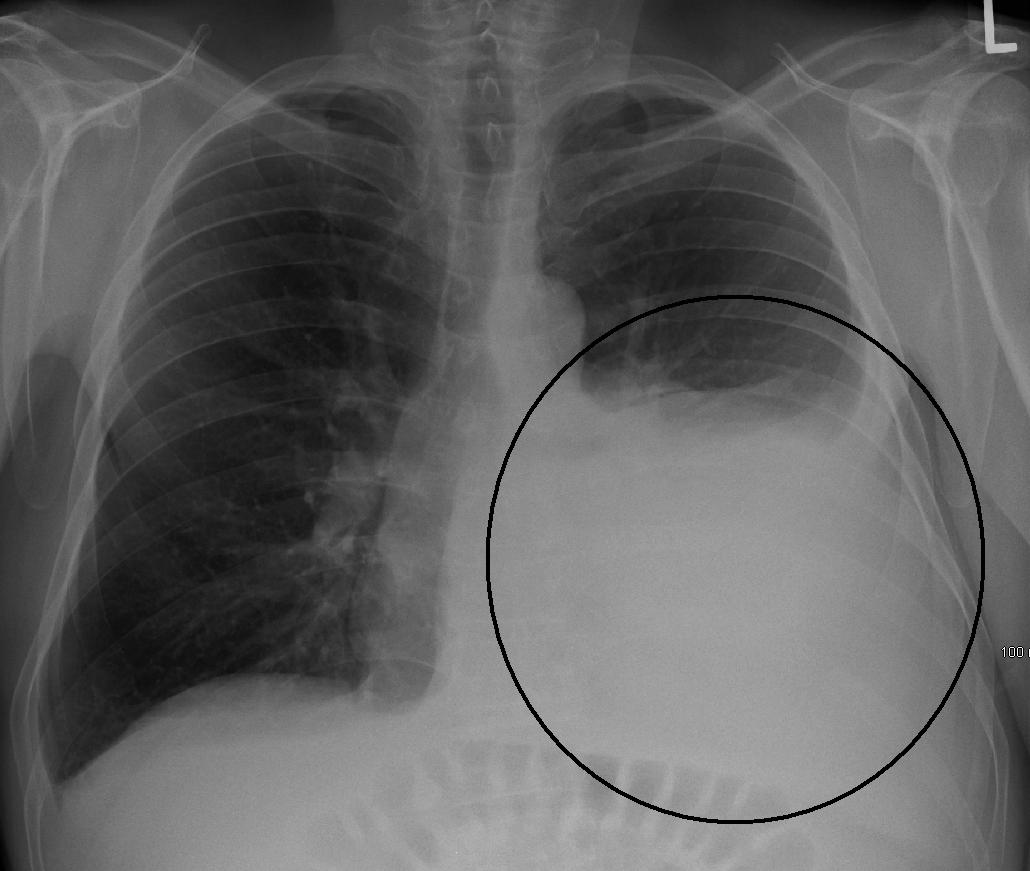 Pleural Effusion Respiratory Medbullets Step 1